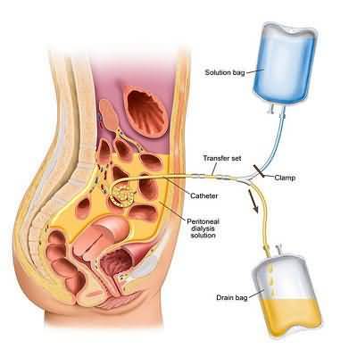 Peritoneal%20Dialysis%20Access.jpg