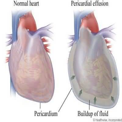 complication_of%20dialysis%20Pericarditis.jpg