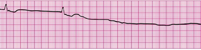 Asystole (Flatline)