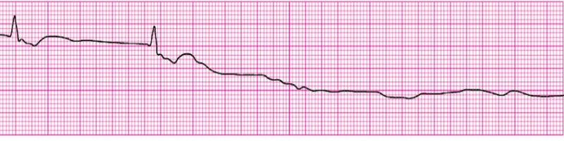 Asystole 1