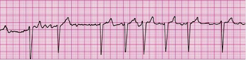 Atrial Fibrillation