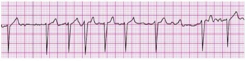 Atrial Fibrillation 1
