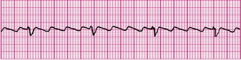 Atrial Flutter