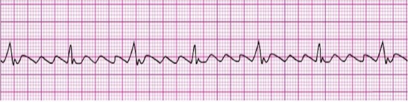 Atrial Flutter
