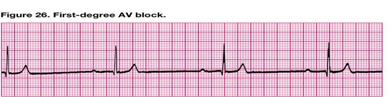 First-Degree AV Block
