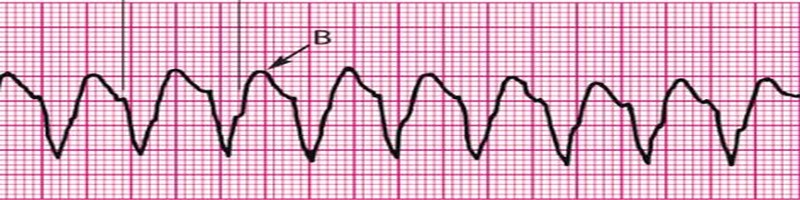 Monomorphic Ventricular Tachycardia