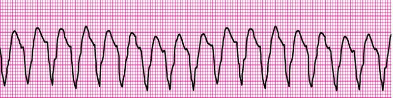 Monomorphic VT 1