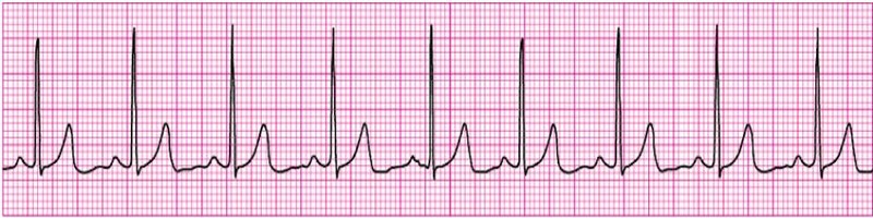 Normal ECG