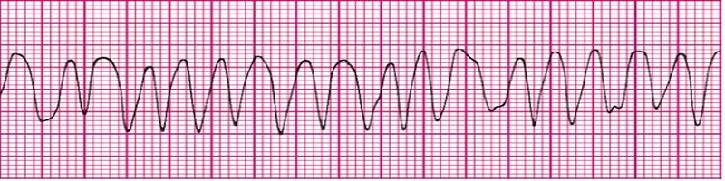 Polymorphic Ventricular Tachycardia