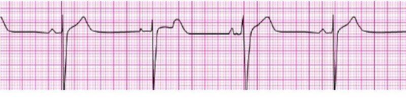 Sinus Brady