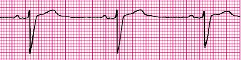 Sinus Bradycardia