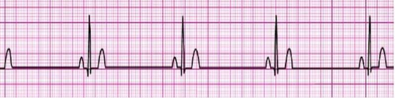 Sinus Bradycardia 1