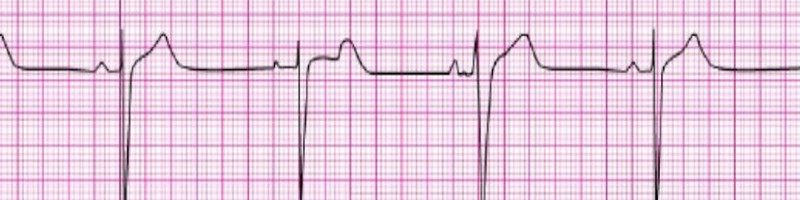 Sinus Bradycardia A