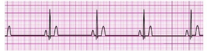 Sinus Brady 2