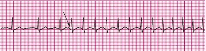 Sinus Rhythm with Reentry SVT