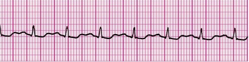 Sinus Tachycardia