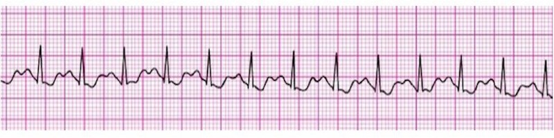 Sinus Tachycardia 1