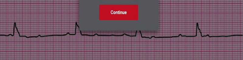 Third Degree Complete Heart Block