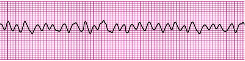 Ventricular Fibrillation