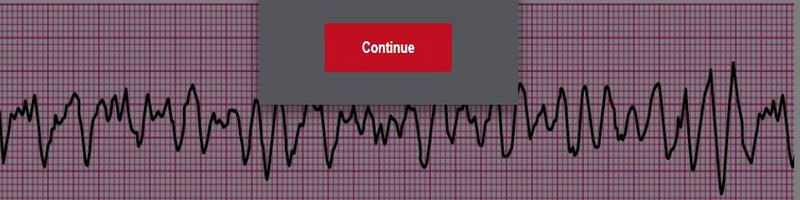 Ventricular Fibrillation 1