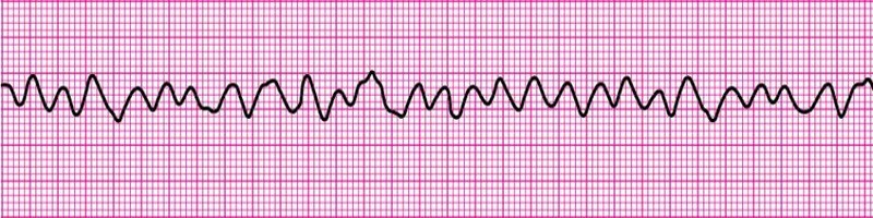 Ventricular Fibrillation