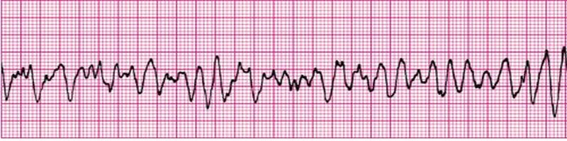 Ventricular Fibrillation Standard