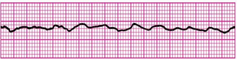 Ventricular Fibrillation