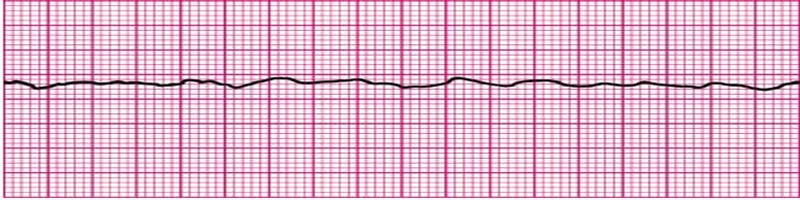 Ventricular Fibrillation