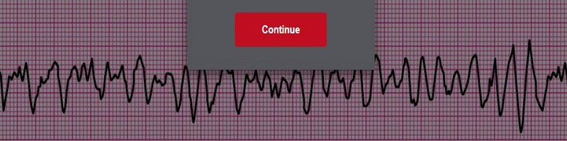 Ventricular Fibrillation 1