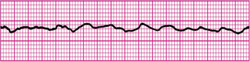 Ventricular Fibrillation (VFF)
