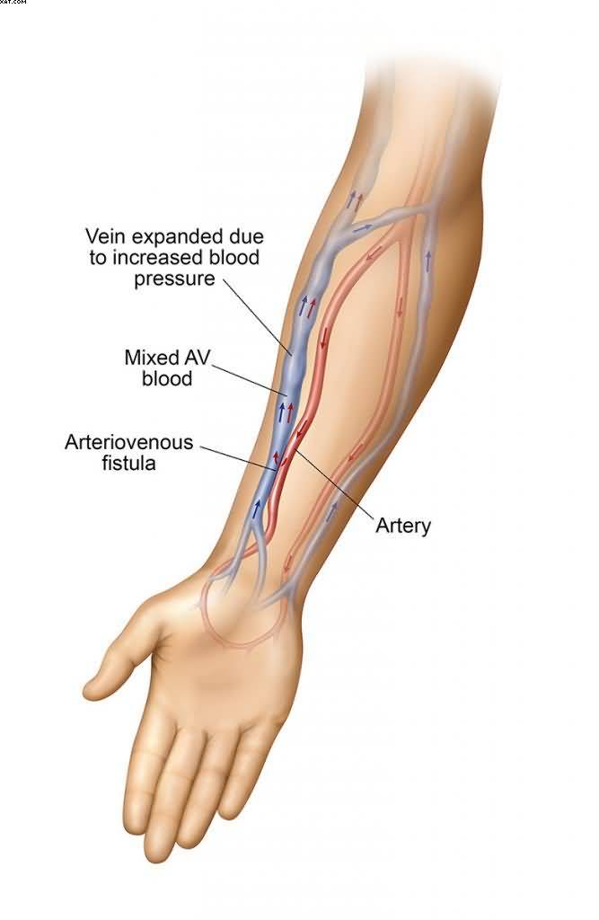 AV-fistula.jpg